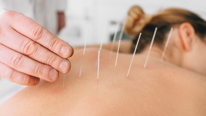 L’acupuncture : les différents bienfaits